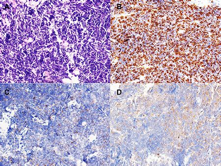 Genetic alterations and protein expression in combined small cell lung ...