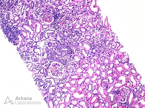 (TINU) Tubulointerstitial Nephritis with Uveitis | Teaching Points