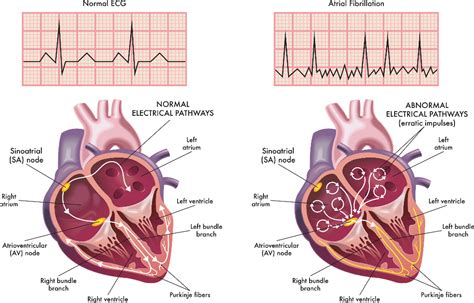 Atrial Fibrillation Causes, Symptoms & Treatment | Dr Raghu