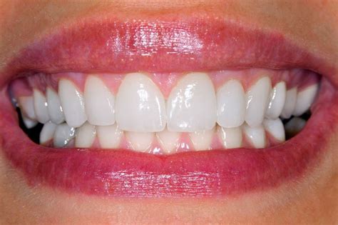 Importance of Having Aligned Teeth