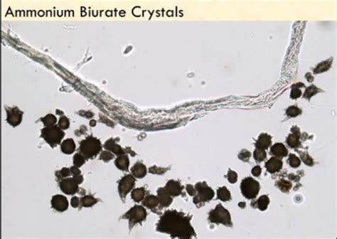 Ammonium biurate Crystals | Medical Laboratories