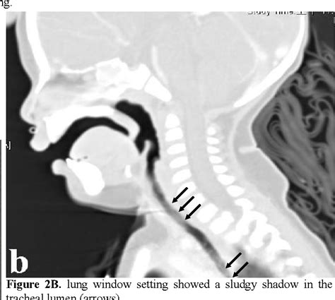 [PDF] Bacterial Tracheitis : A case report | Semantic Scholar