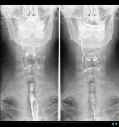 Barium swallow | Radiology Reference Article | Radiopaedia.org | Barium swallow, Radiology ...