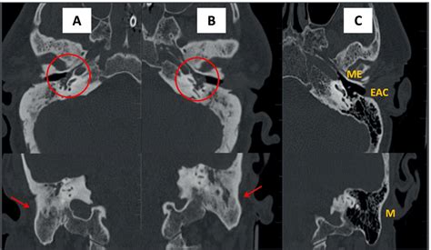 Computed tomography (CT) image of pathological petrous bone [A = right ...