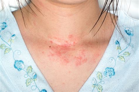 Skin Allergy: Identifying 3 Common Skin Rashes