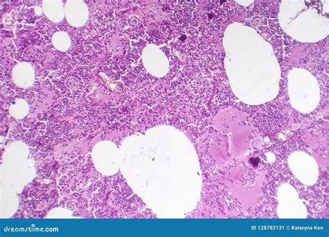 Lobar Pneumonia, Hemorrhagic Edema Period Stock Image - Image of ...