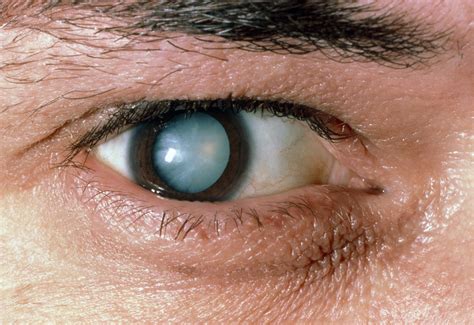 Cataracts Diagnosis and Treatment