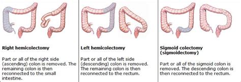 Types Of Colorectal Surgery