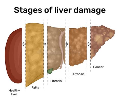 Stages Liver Damage Stock Illustrations – 85 Stages Liver Damage Stock Illustrations, Vectors ...