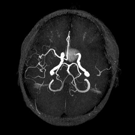 Saccular cerebral aneurysm | Radiology Case | Radiopaedia.org
