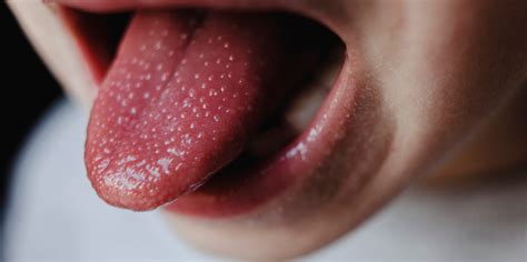 What those bumps on your tongue mean and how to get rid of them