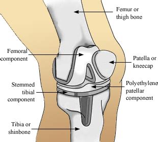 Complete Knee Replacement Surgery, Anatomy & Recovery