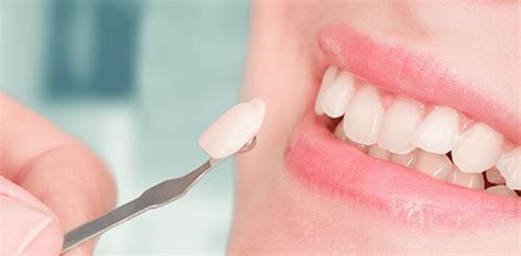 Veneers: Pros And Cons - Women Like That