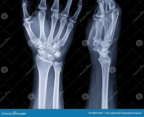 X-ray Image of Wrist Joint for Diagnosis Rheumatoid Arthritis Stock ...