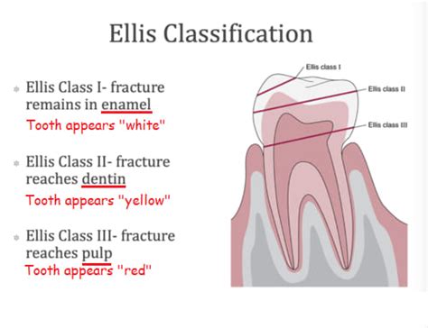 Ellis classification for tooth fracture | News | Dentagama