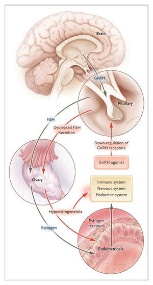 Gonadotropin-Releasing Hormone Agonists for Endometriosis | NEJM