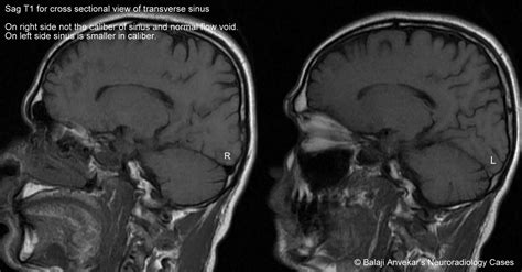 Dr Balaji Anvekar FRCR: Hypoplastic transverse sinus MRI