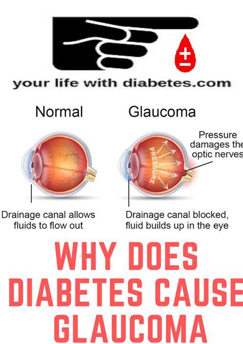 Can Glaucoma Be Caused By Diabetes - DiabetesWalls