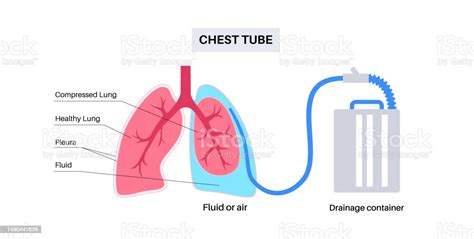 Chest Tube Catheter Stock Illustration - Download Image Now - Tube, Chest - Torso, Lung - iStock