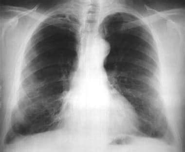 Asbestosis Imaging: Practice Essentials, Radiography, Computed Tomography