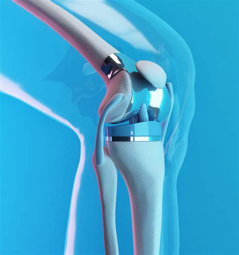 Knee Replacement Surgery In Singapore | Dr Wang Lushun