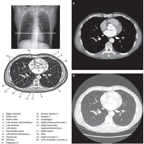 Labeled Chest CT Scan Anatomy