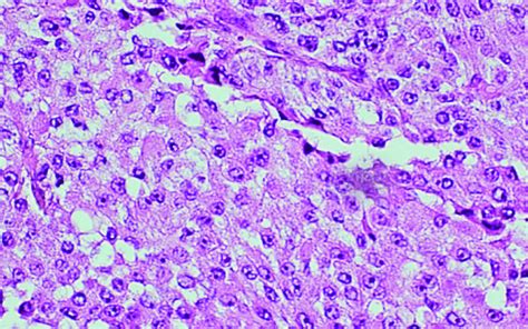 Histopathology slides of adrenal gland oncocytes and classical ...