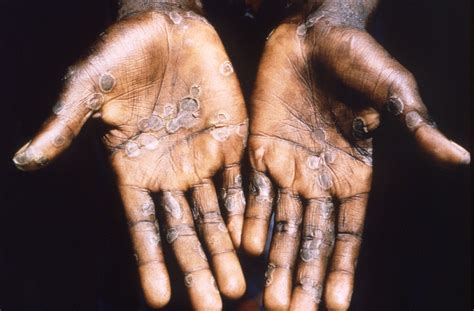 What Does a Monkeypox Rash Look Like? Symptom Progression, Explained - See The Photos | SELF