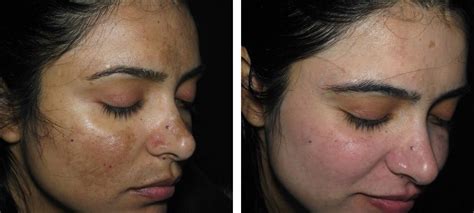 Pigmentation | Before & After | Kingsway Dermatology