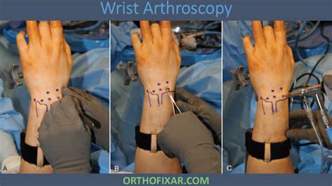 Wrist Arthroscopy • Easy Tutorial • OrthoFixar 2024