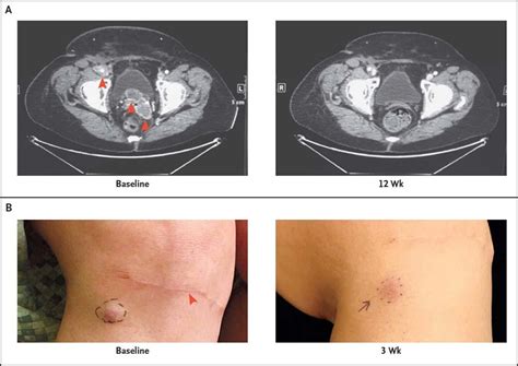 FDA Approves Pembrolizumab to Treat Merkel Cell Carcinoma - National ...