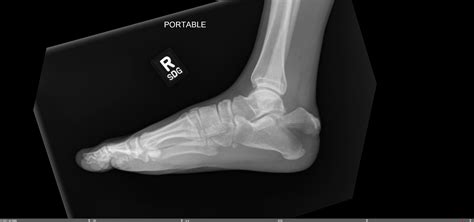 Tongue Type Calcaneus Fracture — Chicago Foot & Ankle Orthopaedic Surgeons