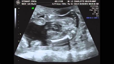 What Does My Baby Look Like At 18 Weeks Ultrasound - Baby Viewer