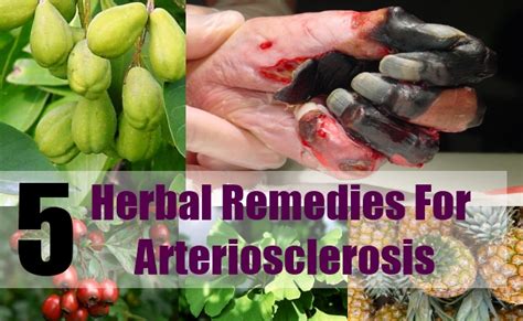 5 Herbal Remedies For Arteriosclerosis – Natural Home Remedies & Supplements