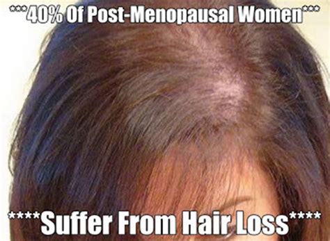 * 40% Of Post-Menopausal Women Suffer From Hair Loss?* Studies Have ...