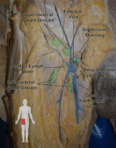 What Drains Into Inguinal Lymph Nodes - Best Drain Photos Primagem.Org