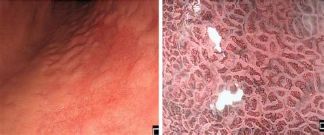 Diagnosis of Helicobacter pylori-related chronic gastritis, gastric adenoma and early gastric ...