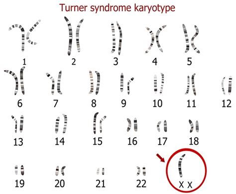 Turner Syndrome - Causes, Symptoms, Life Expectancy, Treatment