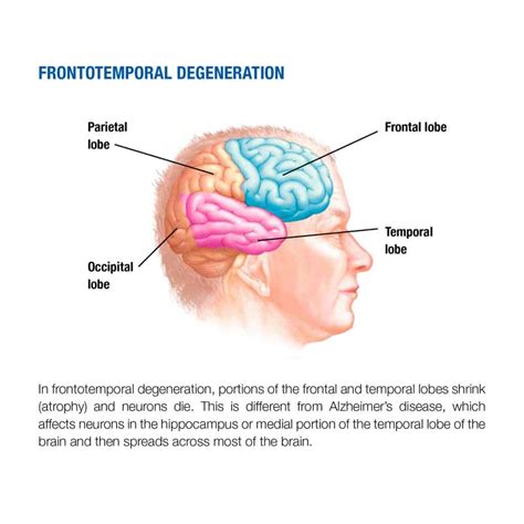 Frontotemporal dementia - Mayo Clinic Press