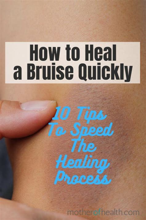 How to heal a bruise quickly and naturally | Mother Of Health