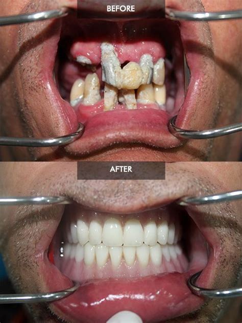 Before and after Fixed Hybrid Dentures | How to whiten dentures, Dental ...