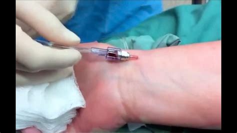 Arterial catheter insertion - YouTube