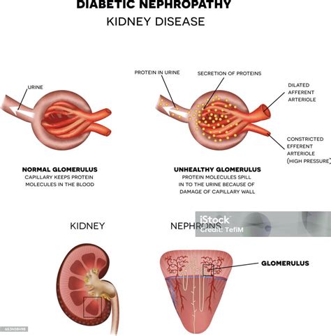 Diabetic Nephropathy Kidney Disease Stock Illustration - Download Image Now - Glomerulus ...