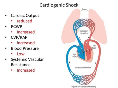 Cardiogenic Shock Signs And Symptoms