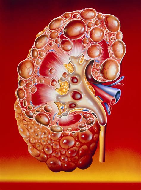 Polycystic Kidney Disease (PKD): The Basics