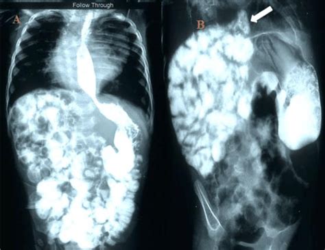 An upper GI series (a) showing normal intra-abdominal location of ...