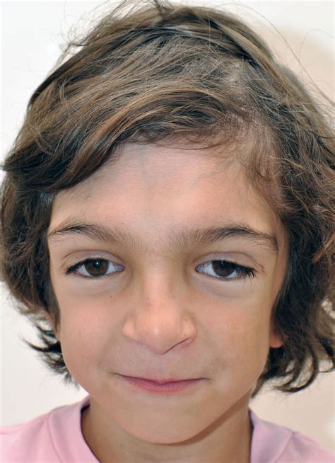 Crouzon Syndrome | Hellenic Craniofacial Center