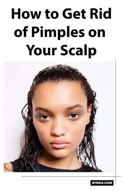 This Is Why You're Getting Pimples on Your Scalp Scalp Pimples Treatment, Pimples On Scalp ...