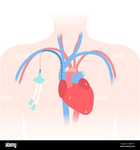 Tunneled central venous catheter placed in the subclavian vein. Patient with CVC long term ...