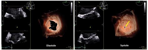 Three-dimensional (3D) echocardiography of the tricuspid valve with... | Download Scientific Diagram